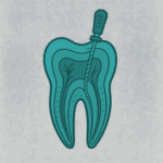 Root Canal